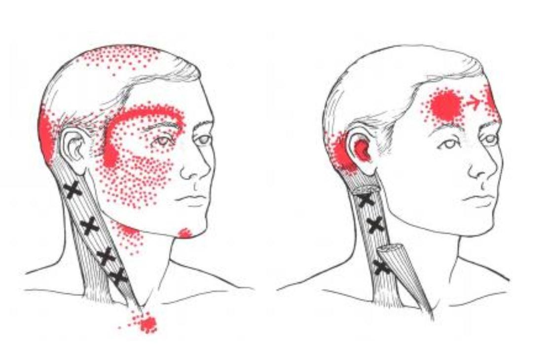 Cervicogenic headache diagram showing nerve pathways from neck to head