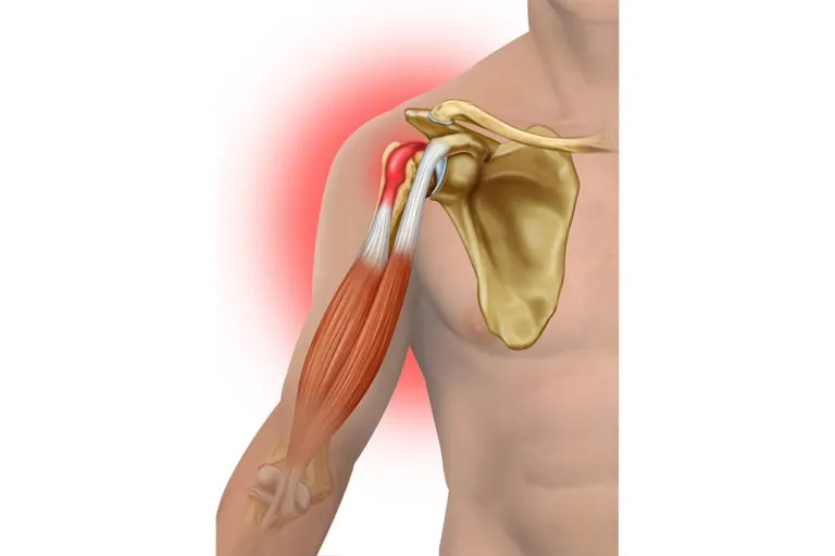 Biceps Tendinitis: Causes, Symptoms & Treatment