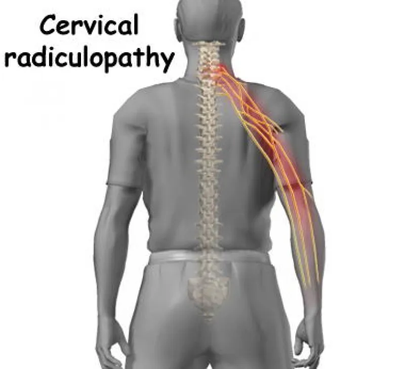 Cervical Radiculopathy: Understanding Your Pinched Nerve in the Neck
