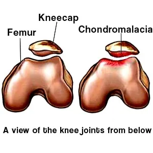 Chondromalacia Patella: The Real Reason Your Knee Hurts
