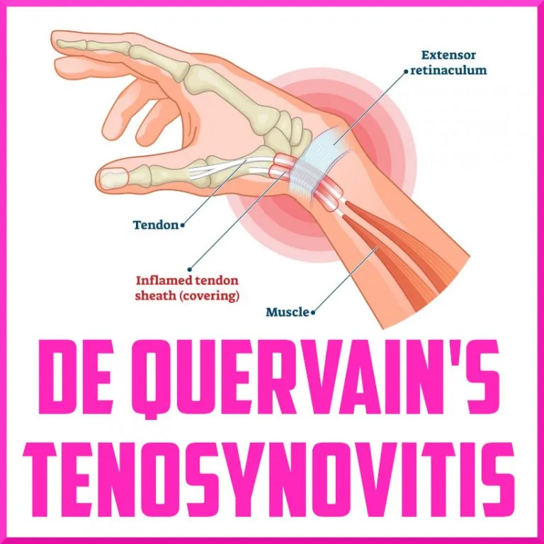 De Quervain's Tenosynovitis: Wrist Pain at the Thumb