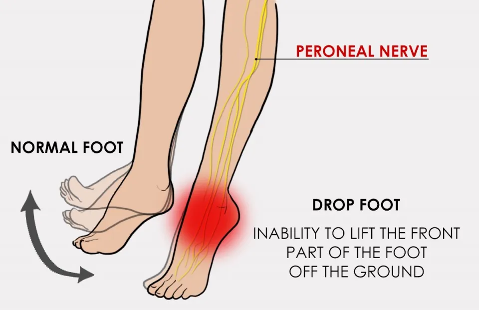 Foot Drop: Causes, Warning Signs & When to See a Chiropractor