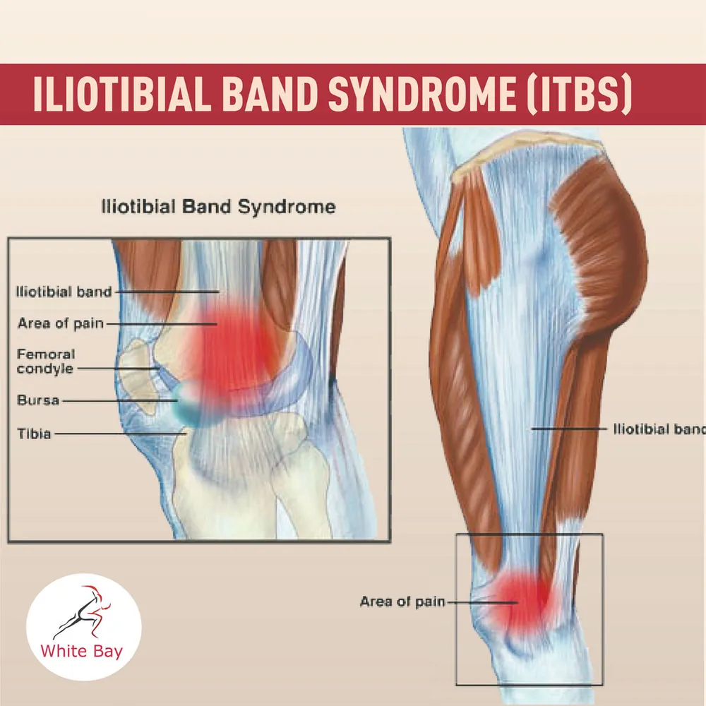 IT Band Syndrome: Why Runners Get Outer Knee Pain