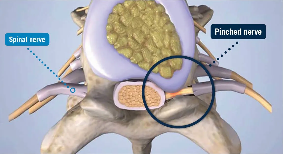 Pinched Nerve: What It Really Means and How Chiropractic Helps