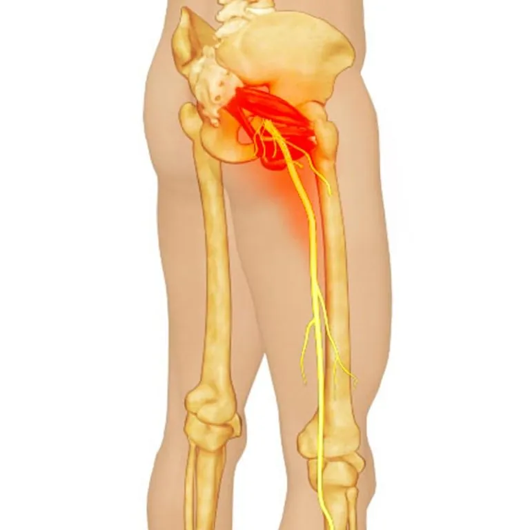 Piriformis Syndrome: The Gluteal Condition That Mimics Sciatica