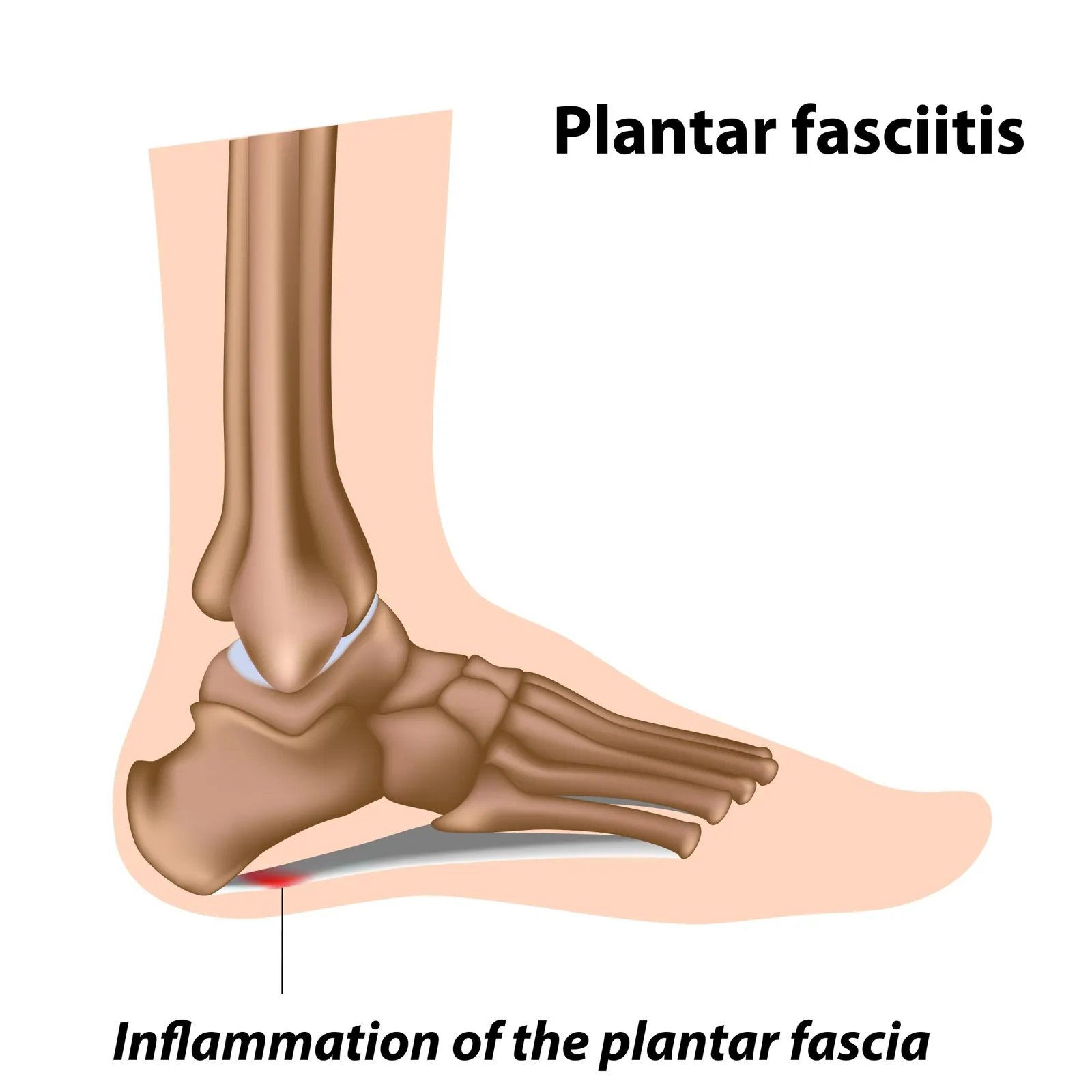 Plantar Fasciitis: Why Your First Steps in the Morning Hurt