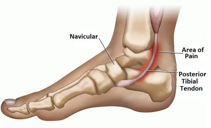 Posterior Tibial Tendonitis: The Ankle Condition That Leads to Flat Feet