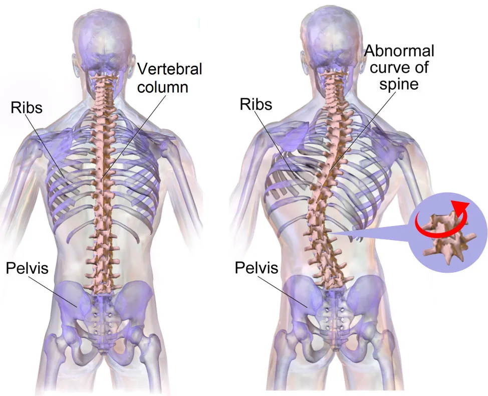 Scoliosis: What Pittsburgh Patients Need to Know