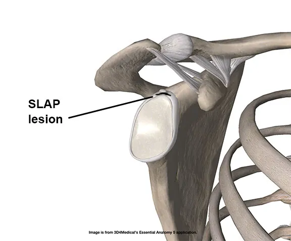 SLAP Tears: The Shoulder Labrum Injury That Sidelines Pittsburgh Athletes