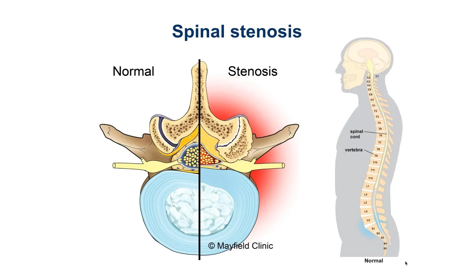 Spinal Stenosis: Why Walking Hurts More Than Sitting