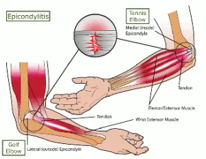 Tennis Elbow vs. Golfer's Elbow: Understanding Epicondylitis and How to Treat It
