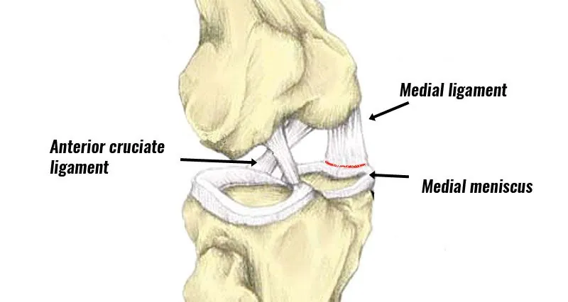 The Unhappy Triad: ACL, MCL, and Meniscus Injuries in Pittsburgh Athletes