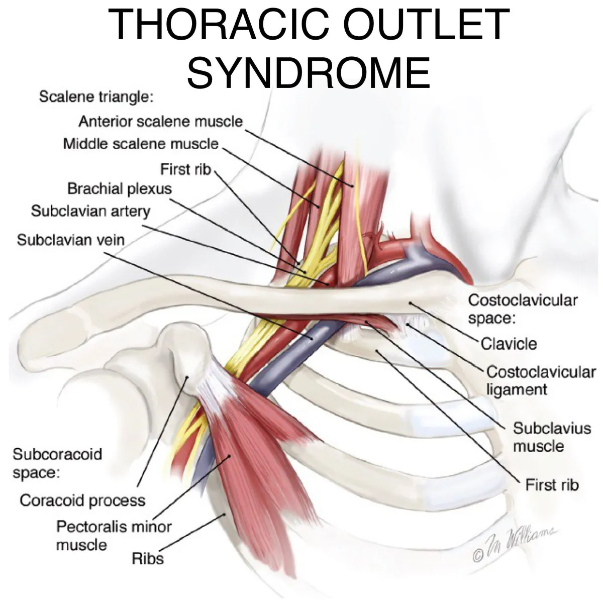 Thoracic Outlet Syndrome: The Misdiagnosed Cause of Arm Numbness