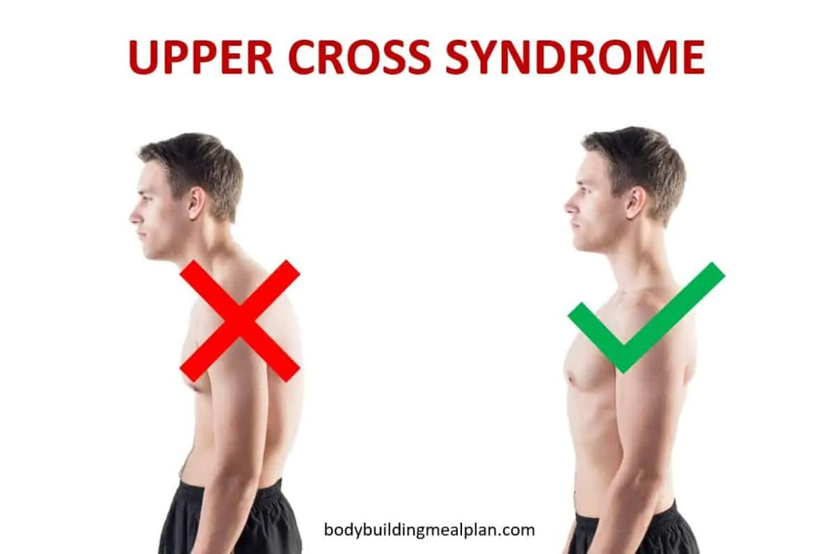 Upper Crossed Syndrome: The Posture Problem Behind Neck and Shoulder Pain