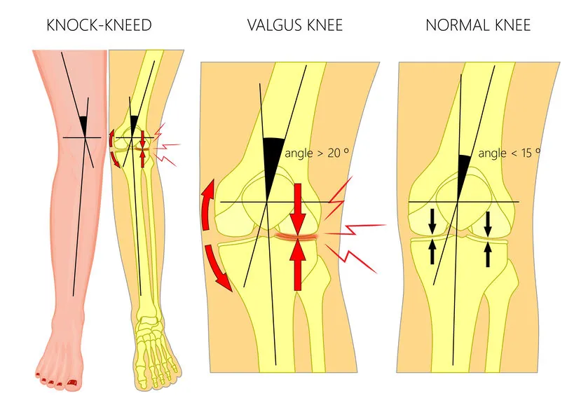 Valgus Knee: How Alignment Problems Cause Pain from Hip to Foot