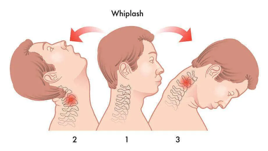 Whiplash After a Pittsburgh Car Accident: What You Need to Know