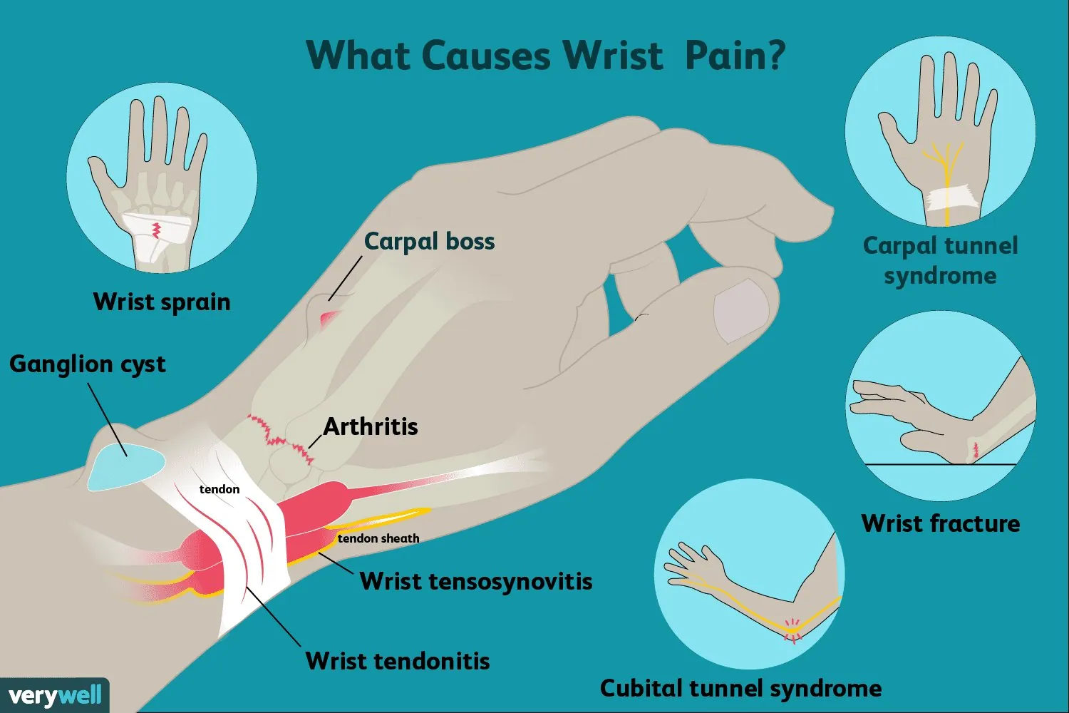 Wrist Pain in Pittsburgh: Carpal Tunnel, Tendinitis, and What's Actually Causing It